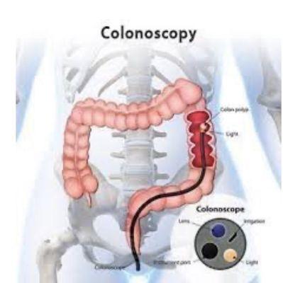 Outstanding Colon Cancer Prevention Program