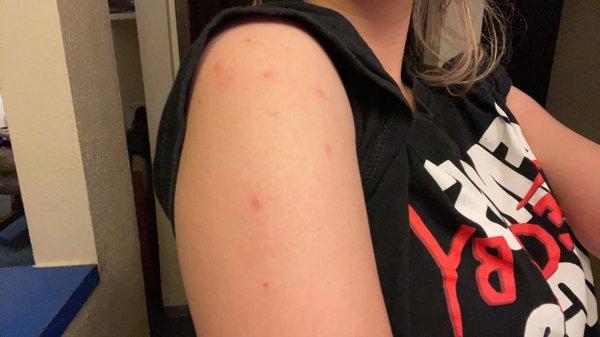 Bed bug bites on left arm