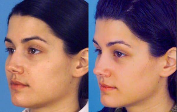 Rhinoplasty Before and After. Learn more about rhinoplasty at http://www.drgregpark.com/nose-surgery