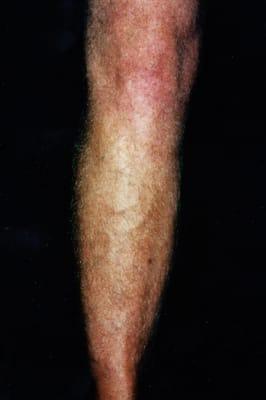 varicose veins after therapy