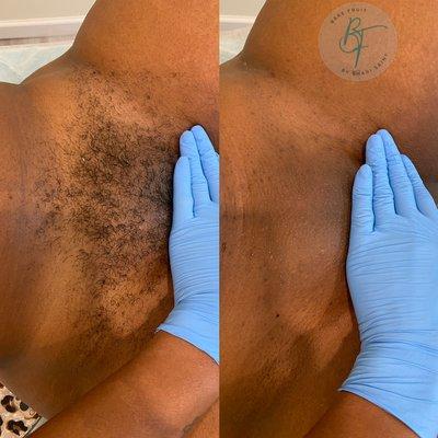 Brazilian sugaring