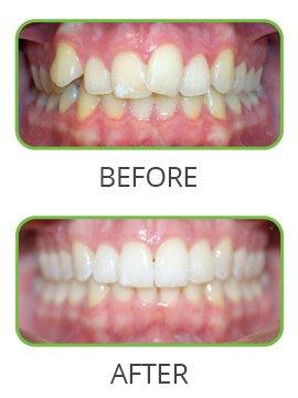 Start the new year with a beautiful smile! Call today to get started on clear braces!!