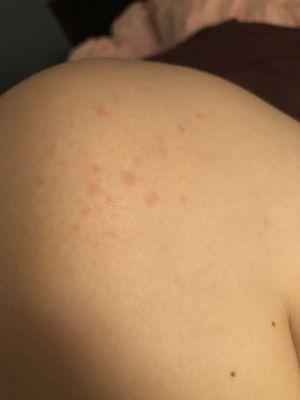 Bites from bed bugs