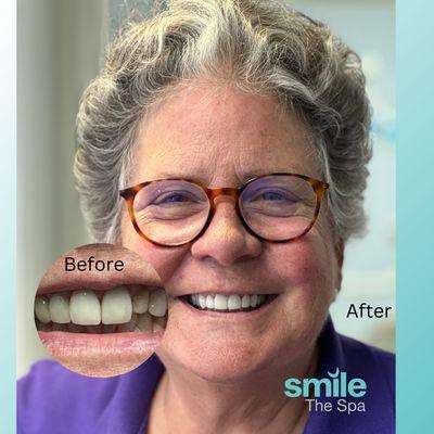 Our patient Reba before and after veneers at Smile The Spa