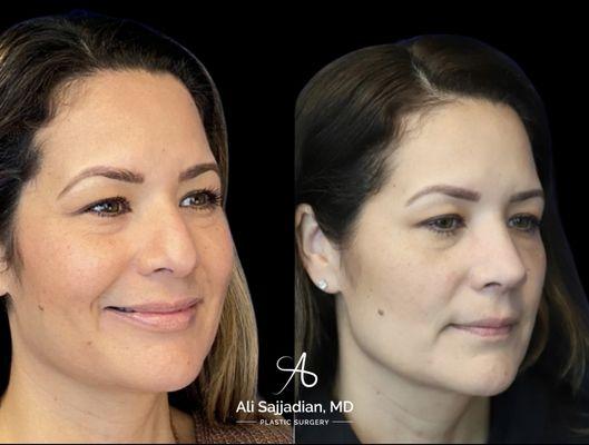 Before and After | Surgical Rhinoplasty