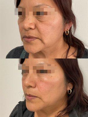 Nasal Labio & Cheek Filler