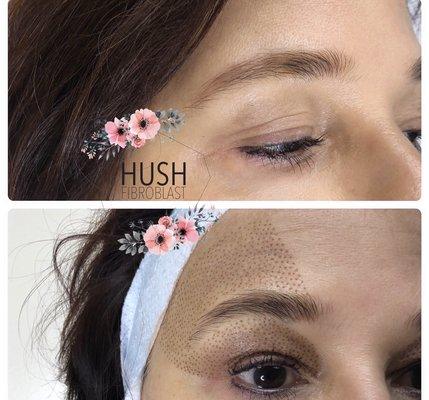 Upper eyelid lift with brow enhancement.