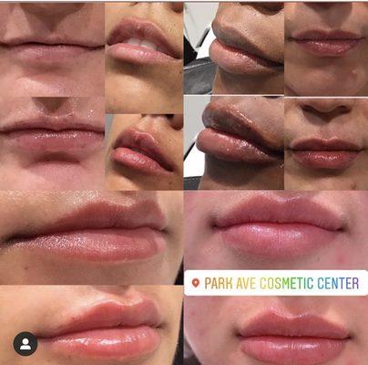 Lip Filler/ Lip Injections/ Best Lips/ Best Botox/ PDO Threads/ Chemical Peels/ Laser/ Filler/ Dermal Filler