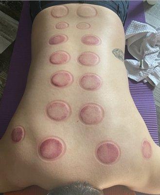 Cupping Meridian work connective tissue injury rehabilitation.