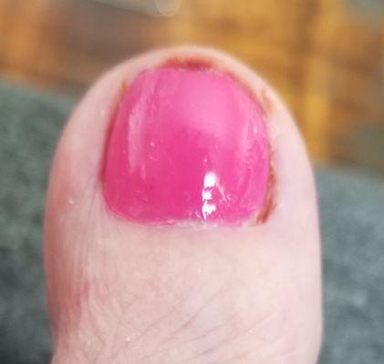 Dried blood after toe was cut and polish applied