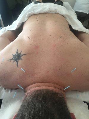 ACUPUNCTURE