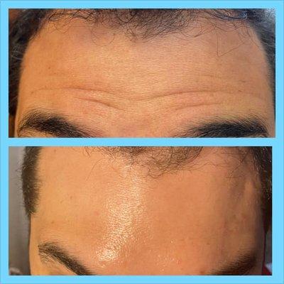 Men's Wrinkle Reduction Before and After