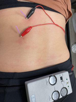 Electro + Dry Needling