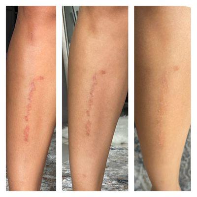 scar and stretch marks camouflage, really good results