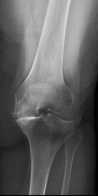 Degenerative joint condition. Before knee replacement.