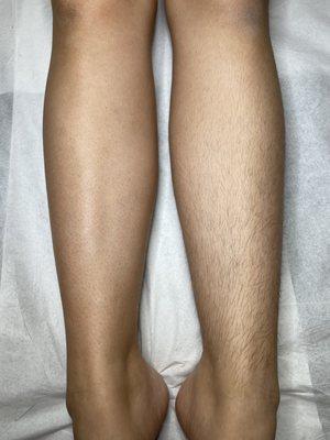 Comparison: one waxed leg and one non-waxed leg