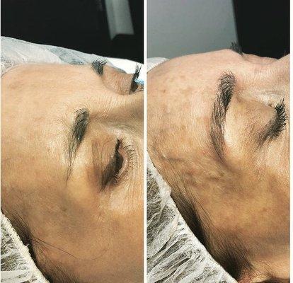 Microblading