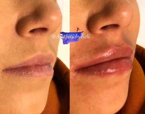 Lip augmentation