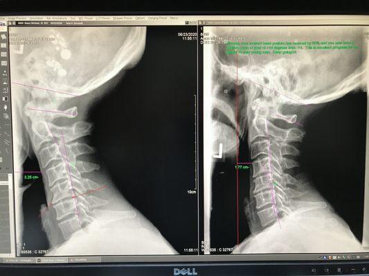 Before and after x-rays of my neck condition. The x-ray on the left his before treatment.