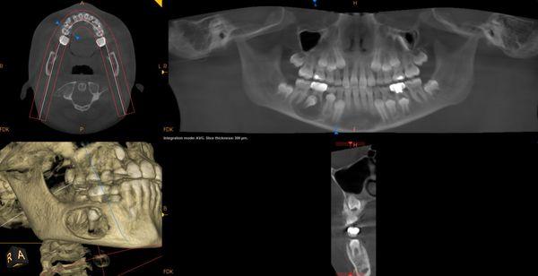 Lower Jaw cyst on a 9 year old patient