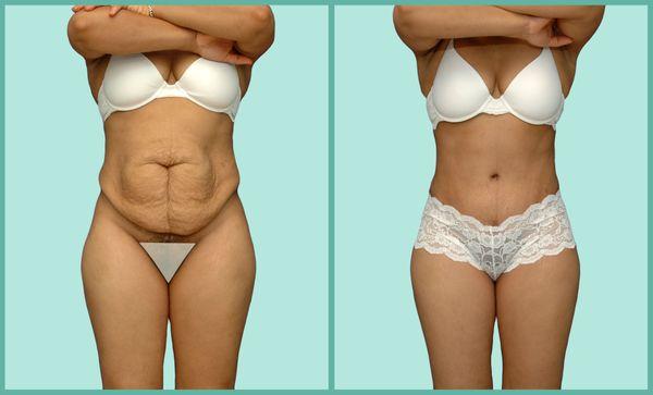 Tummy Tuck after Pregnancy