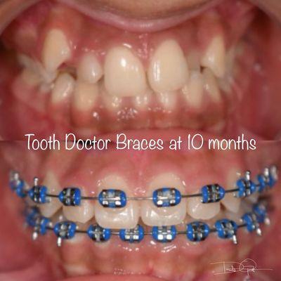 Tooth Doctor braces at 10 months