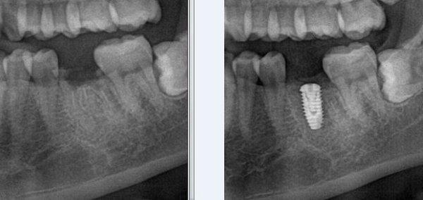 Broken Root canal treated tooth replaced with Implant by Dr.Kim