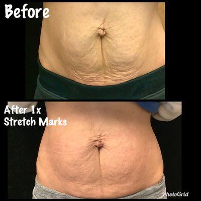 Stretch mark removal