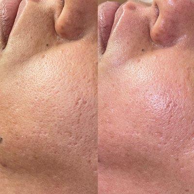 Before and after Microneedling facial ONE TREATMENT Instant results! - Reduces pore size,  acne marks, dark spots and dead skin .