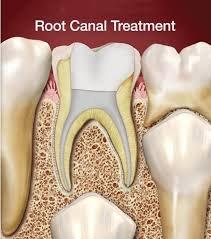 San Antonio Dentist Root Canals