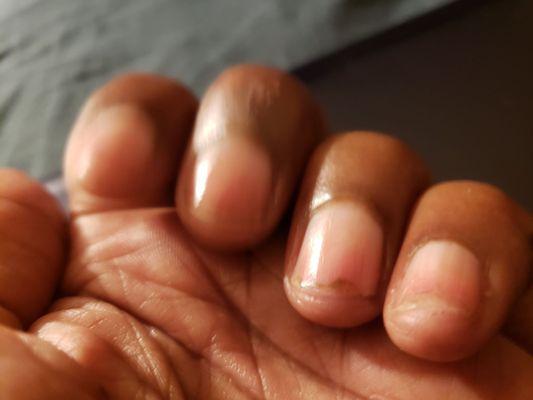 Nails growth stunted due to clipping on the ends.