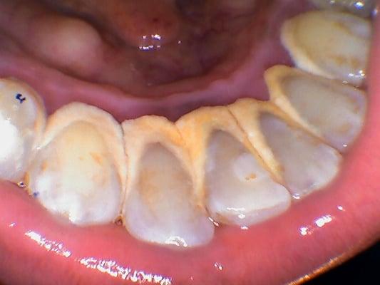 BEFORE photo of patient (634) with severe tartar buildup on backs of lower teeth.