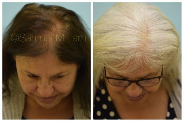 This 64-year-old patient is shown before and nine months after starting topical finasteride therapy for her hair loss.