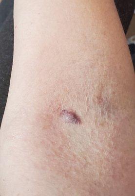 Hematoma, sloppy blood draw