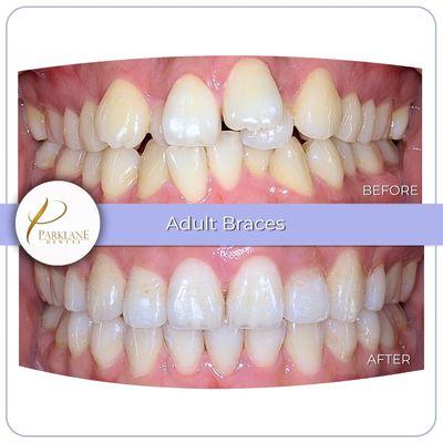 Braces treatment to correct overcrowding, overbite, overjet, and crossbite.