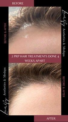 PRP hair restoration. After two sessions.