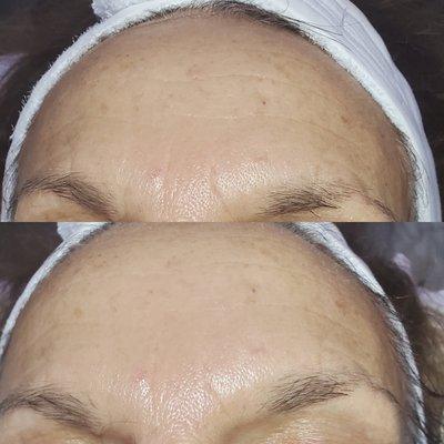 1st session before/after antiaging facial.