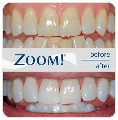 We offer Zoom Whitening - call us today for a consultation