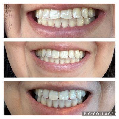 Top- prior to whitening Middle- 24 hrs after Bottom- 1 week later with advanced whitening kit