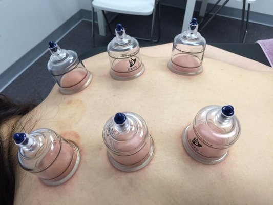 Cupping is good to relieve pain