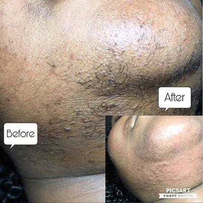 chin hair removal