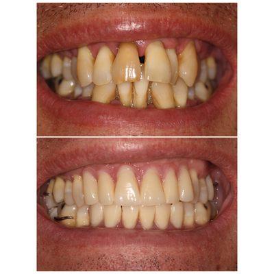 Cosmetic partial dentures