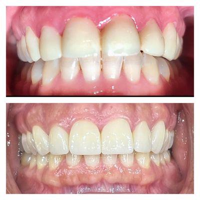 Patient came into the office unhappy with their front six veneers.  They wanted them to look the same color and look more natural.