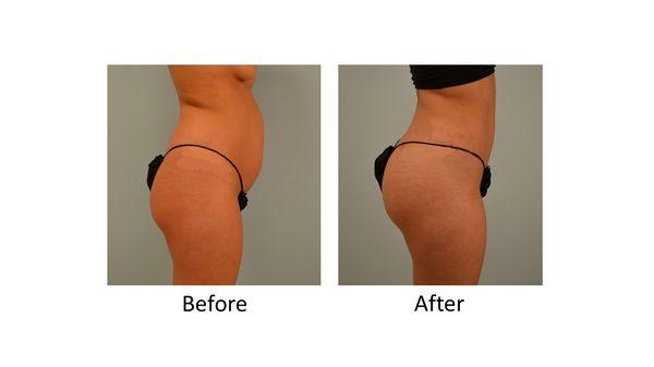 This patient received liposuction of her hip rolls & abdomen as well as a Brazilian Butt Lift.