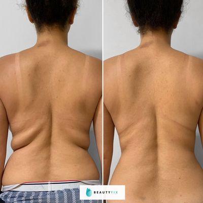 Coolsculpting and Radiofrequency skin tightening, ONE session of each