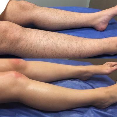 leg wax before and after