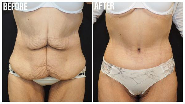 Tummy Tuck/Abdominoplasty