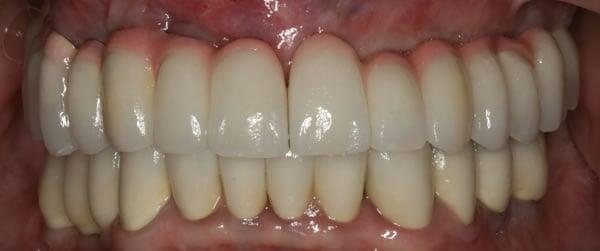 After dental implants.