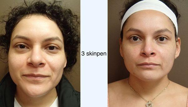 3 skinpen Microneedling sessions each performed 1 month apart.