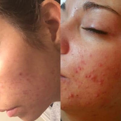 This is my facial transition after chemical peels & IPL therapy. Right pic is BEFORE Felicia-- Left pic is mid-way thru our process!